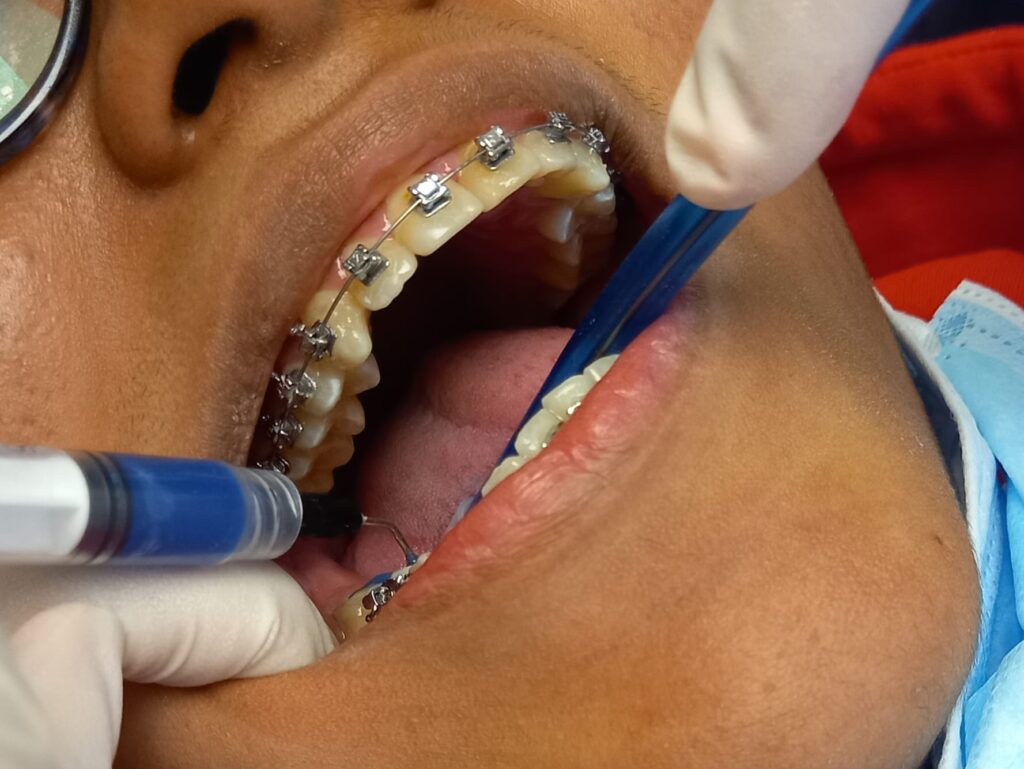 tatamiento-ortodoncia-ohi