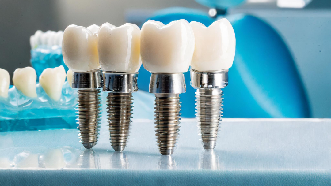 Implantes de carga inmediata: dientes fijos en un día