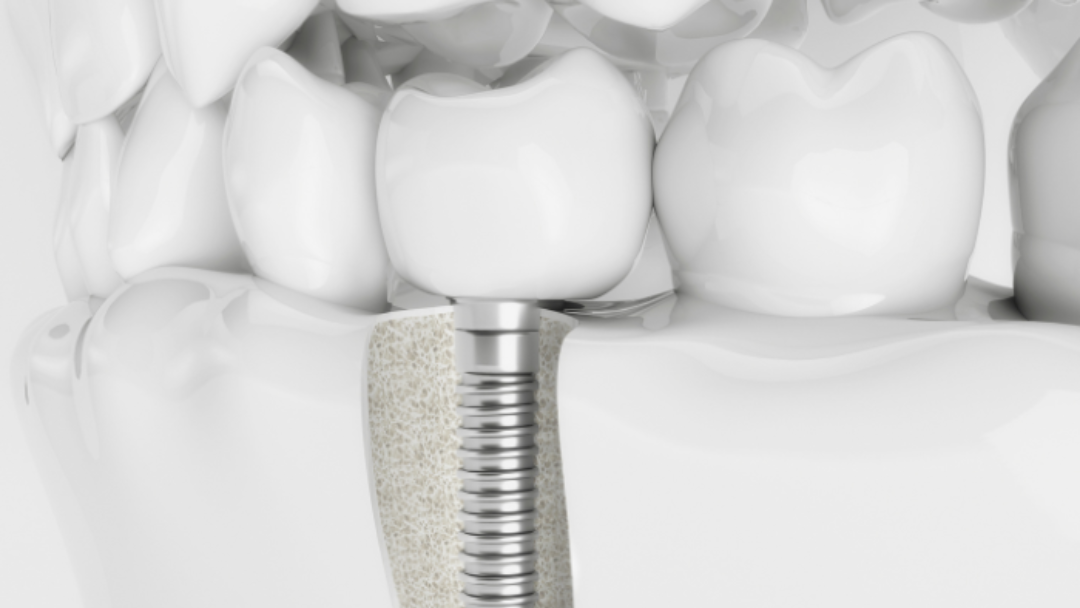 Implantología avanzada, el futuro de los implantes dentales