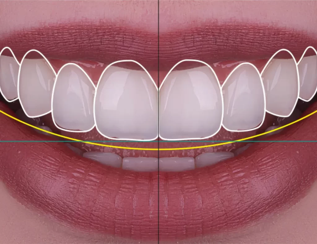 Primer plano de una sonrisa con líneas de diseño sobrepuestas, utilizadas para planificar el diseño digital de la sonrisa y la armonía dental.
