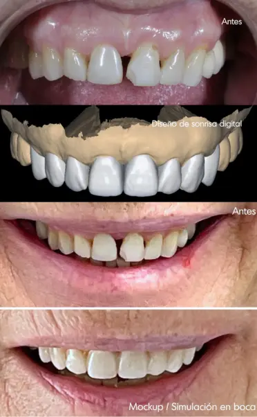 Diseño de sonrisa digital en Madrid