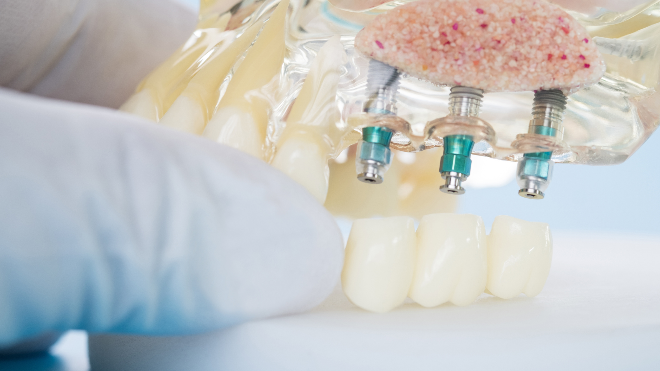 Implante dentales en modelo artificial para mostarlos