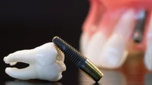 Primer plano de un implante dental de metal, con forma de tornillo, junto a un modelo de diente, con un modelo de encía y dentadura en el fondo.