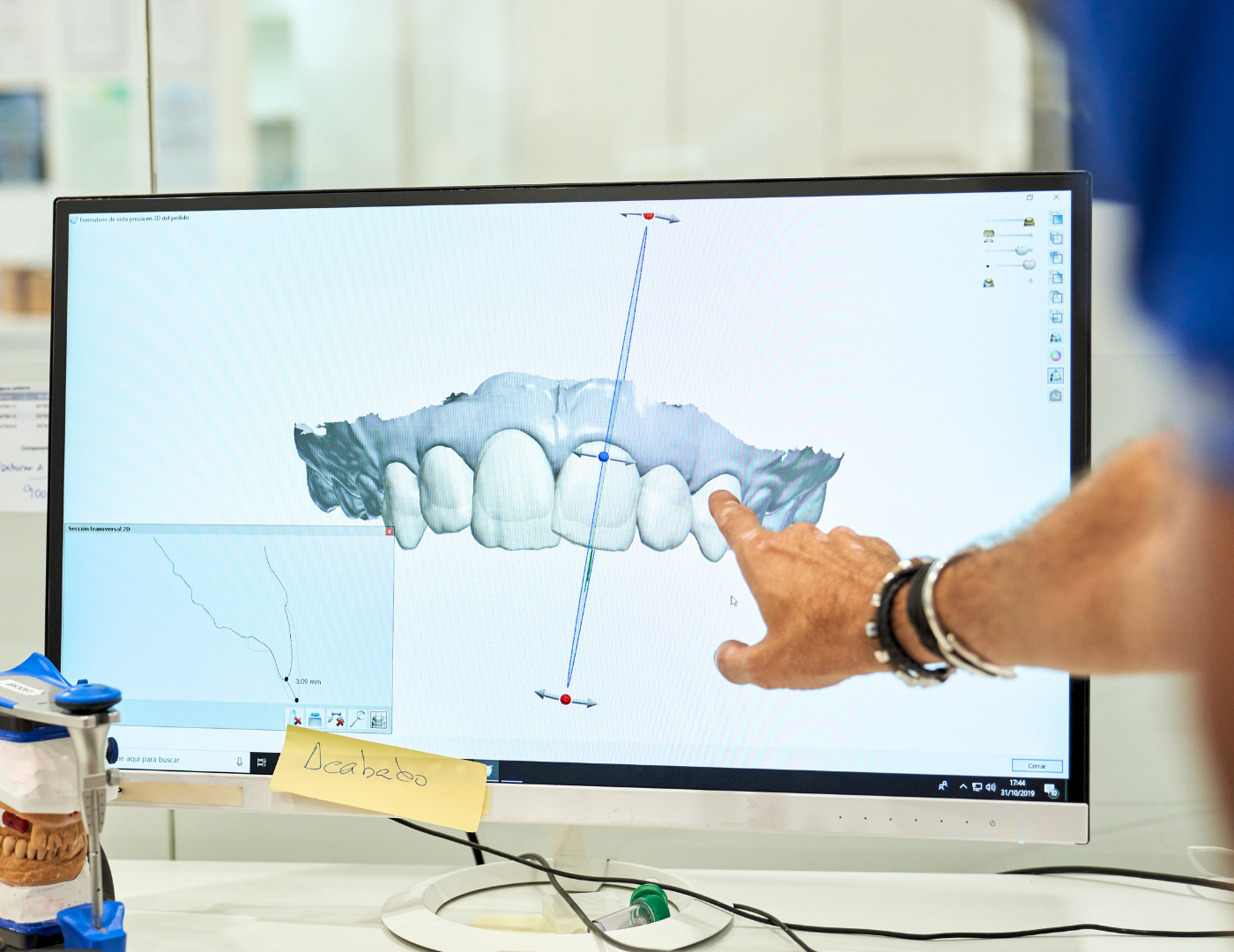 Prótesis sobre implantes en Madrid
