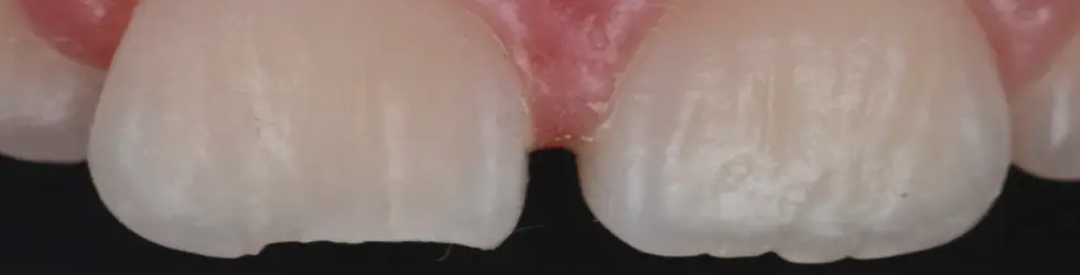 Fractura de Esmalte (Ellis Clase I)