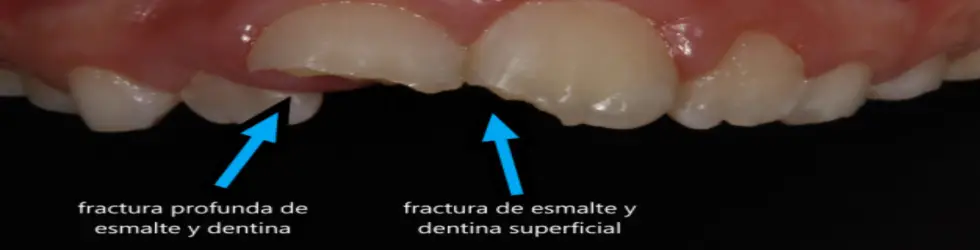 Fractura de Esmalte y Dentina (Ellis Clase II)