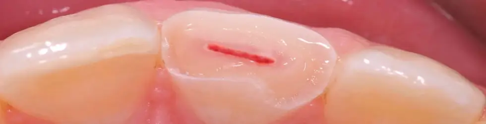 Fractura con Exposición Pulpar (Ellis Clase III)