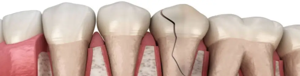 Fractura dental de Raíz
