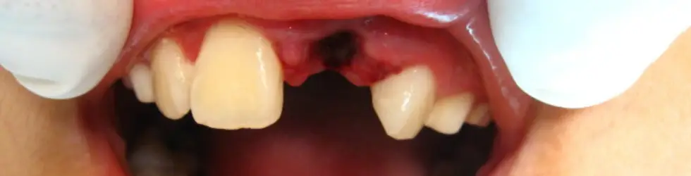 Avulsión Dental Completa