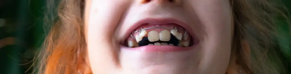 Ortodoncia interceptiva