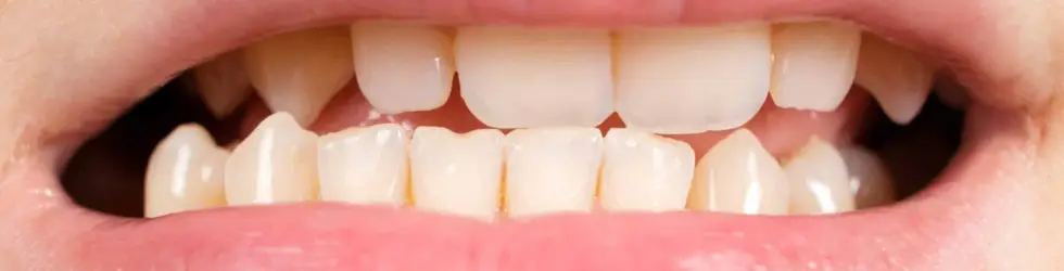 Mordida cruzada posterior unilateral con desviación mandibular