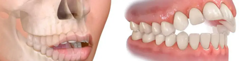 Mordida abierta anterior con interposición lingual