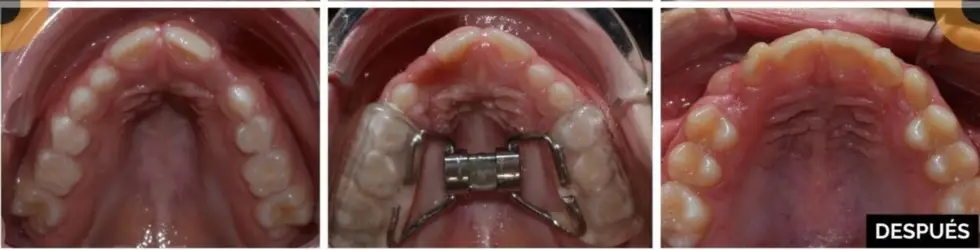 Respiración oral crónica con paladar ojival