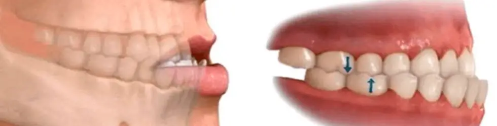 Clase III esquelética (mentón prominente) antes de los 8 años