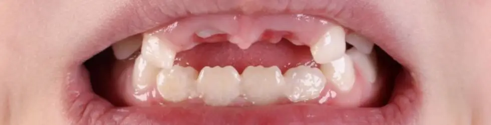 Pérdida prematura de dientes temporales por caries o traumatismos