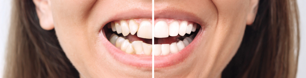 Resultado de carillas dentales en paciente de clínica dental hospitalaria OHI en Madrid antes y después del tratamiento
