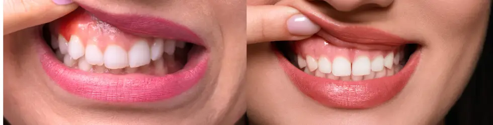 Comparación clínica entre encías sanas y encías con gingivitis en paciente adulto tratado en OHI Valladolid