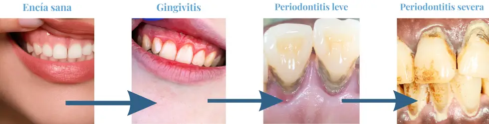 Diagrama de progresión de gingivitis a periodontitis en cuatro etapas: encía sana, gingivitis, periodontitis leve y periodontitis severa