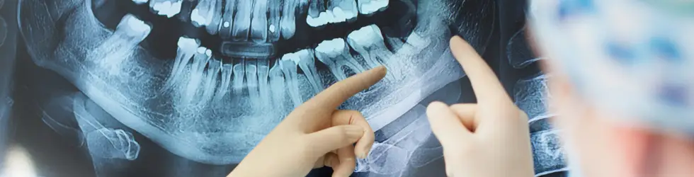 Profesionales revisando radiografía panorámica con muela del juicio para diagnóstico de dolor dental en Madrid